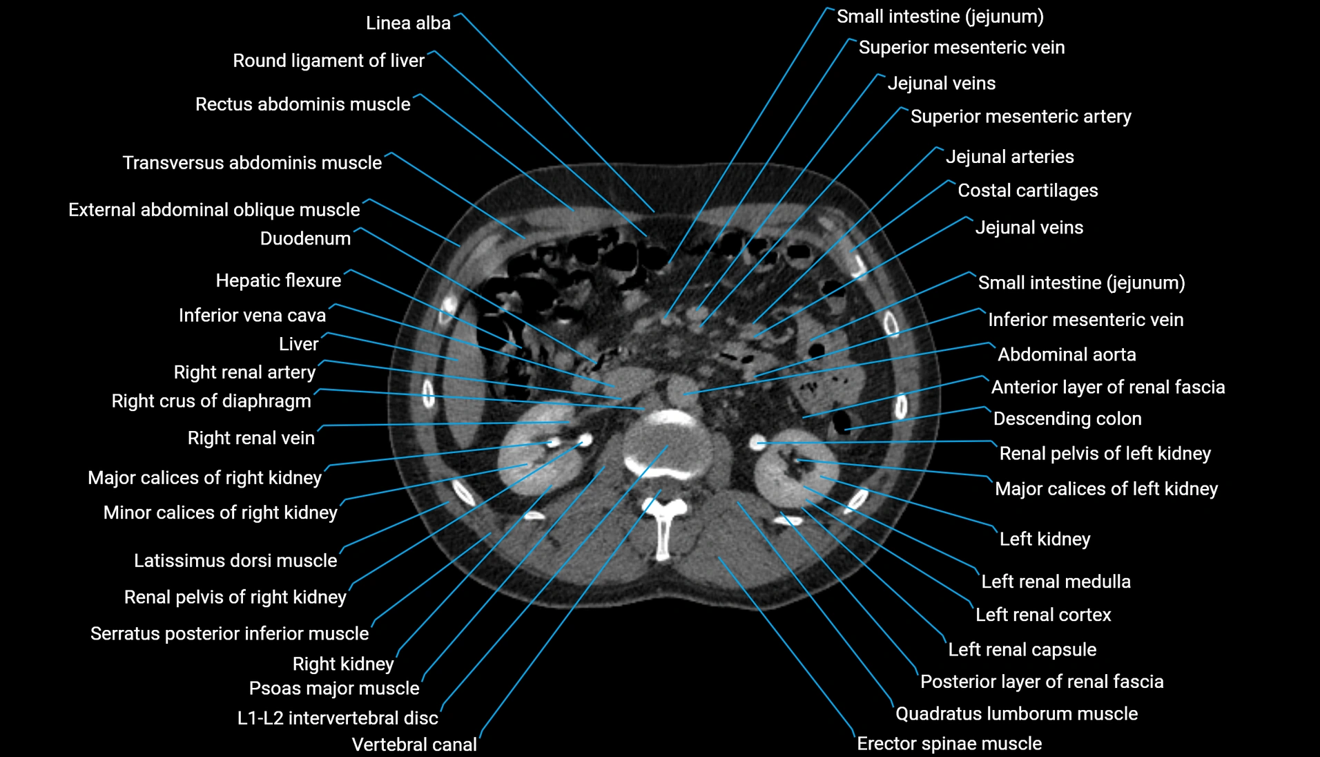 CT urogram axial cross sectional anatomy  labelled radiology image-00105.webp